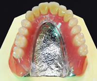 金属床義歯