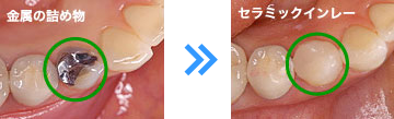 白い詰め物(セラミックインレー)
