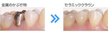白いかぶせ物(セラミッククラウン)
