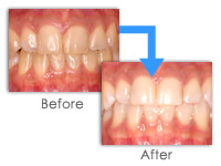 ホワイトニングとは？