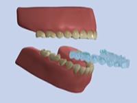 ホームホワイトニング