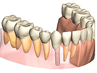 インプラントとは