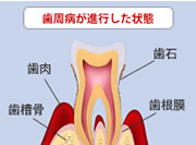 歯周病が進行した状態